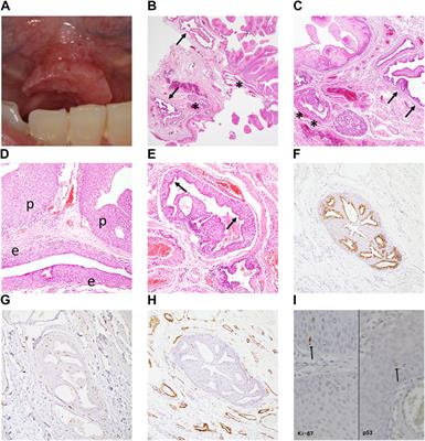 Case Report: Papillary Lesions at the Mouth Floor May Mimic Sialadenoma Papilliferum